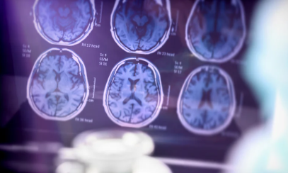 Treatment Advances for Agitation in Alzheimer’s Disease Banner